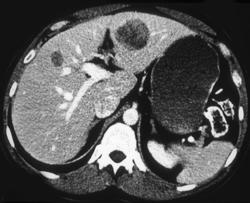 Liver Metastases - CTisus CT Scan