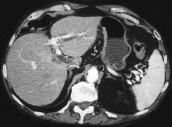 Cholangiocarcinoma - CTisus CT Scan