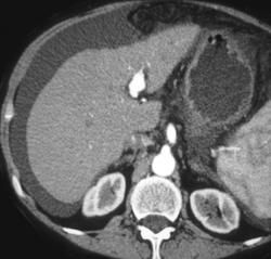 Cirrhosis With Varices and Hepatic Aa. Arteriovenous Malformation (AVM) - CTisus CT Scan