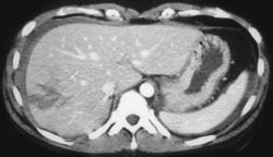 Liver Laceration - CTisus CT Scan