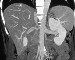 Small Hepatoma in 3D - CTisus CT Scan