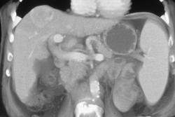 Hepatoma in Cirrhotic Liver - CTisus CT Scan