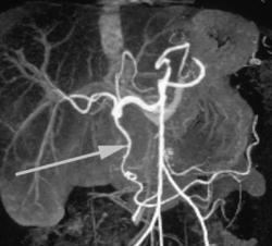 Normal Hepatic Artery and Gastroduodenal Artery (GDA) Arcade - CTisus CT Scan