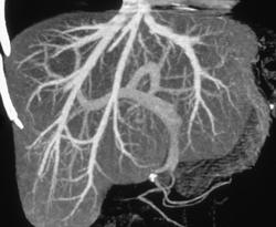 Normal Liver Vasculature - CTisus CT Scan