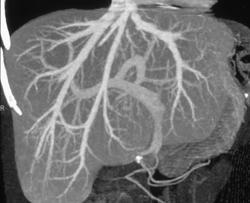 Normal 3D Liver - Liver Case Studies - CTisus CT Scanning