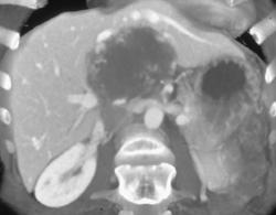 Hemangioma - CTisus CT Scan