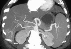 Hepatoma With Neovasculature Without A Discrete Mass - CTisus CT Scan