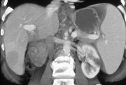 Multifocal Hepatoma - CTisus CT Scan