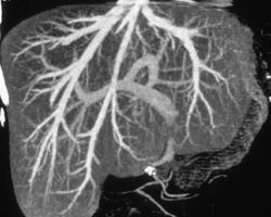 Normal Hepatic Venous and Arterial Anatomy - CTisus CT Scan