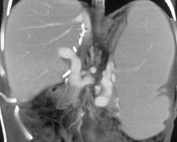 Post Liver Transplant With Splenomegaly - CTisus CT Scan