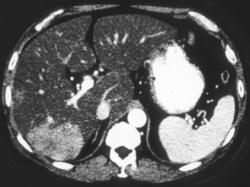 Liver Metastases in A Fatty Liver - CTisus CT Scan