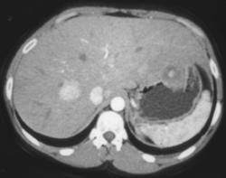 Focal Nodular Hyperplasia - CTisus CT Scan