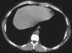 Hepatoma - CTisus CT Scan