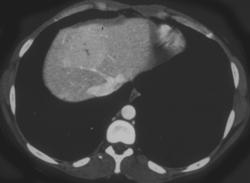 Hepatoma With Subtle Scar - CTisus CT Scan