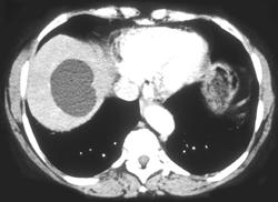 Liver Cyst - CTisus CT Scan