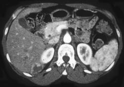 Hemangioma - CTisus CT Scan