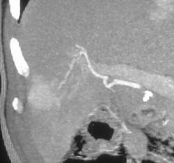 Hepatoma With Feeding Vessel - CTisus CT Scan