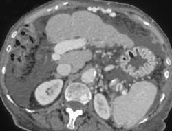 Cirrhosis With Huge Varices - CTisus CT Scan