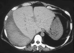 Subcapsular Hematoma S/P Biopsy - CTisus CT Scan