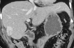 Hepatoma - CTisus CT Scan