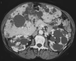 Polycystic Kidney and Liver Disease - CTisus CT Scan