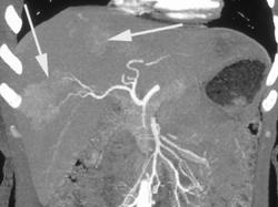 Ct Angiographic Neovascularity With Multifocal Hepatoma - CTisus CT Scan