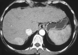 Hepatoma in A Cirrhotic Liver - CTisus CT Scan