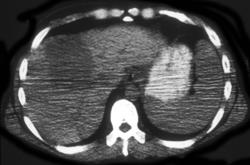 Metastatic Melanoma With Negative Pei - CTisus CT Scan