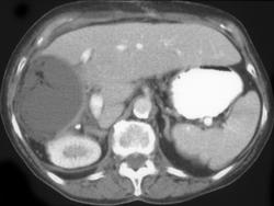 Postoperative Site Packed With Mesentery - CTisus CT Scan