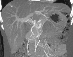 Normal Hepatic Artery - CTisus CT Scan