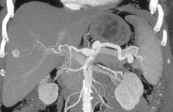 Hepatoma - CTisus CT Scan