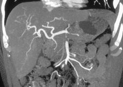 Normal Hepatic Arterial Anatomy - CTisus CT Scan