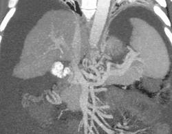 Cirrhosis With Varices - CTisus CT Scan