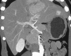 Hepatoma - CTisus CT Scan