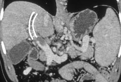 Transjugular Intrahepatic Portosystemic Shunt (TIPS) With Clot in Portal Vein - CTisus CT Scan