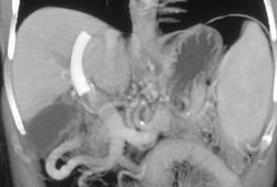 Normal Hepatic Artery. Transjugular Intrahepatic Portosystemic Shunt (TIPS) in Portal Vein (PV) - CTisus CT Scan