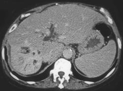 Cholangiocarcinoma - CTisus CT Scan