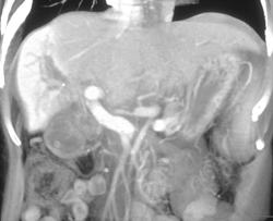 Flow Changes Due to Cholangiocarcinoma - CTisus CT Scan