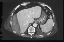 Hepatic Laceration With Bleed - CTisus CT Scan