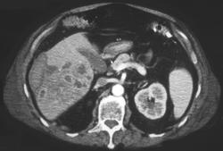 Hepatoma With Subcapsular Bleed - CTisus CT Scan