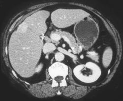 Hepatoma - CTisus CT Scan