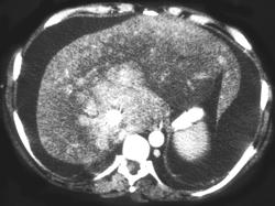 Budd-Chiari Syndromne - CTisus CT Scan