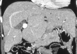 Primary Biliary Cirrhosis (PBC) With Tumor - CTisus CT Scan