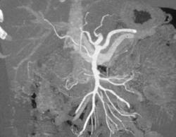 Replaced Right Hepatic Artery Off the SMA - CTisus CT Scan