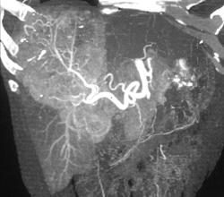 Hepatoma With Neovascularity - CTisus CT Scan