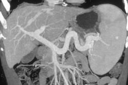 Cirrhosis With Patent Portal Vein - CTisus CT Scan