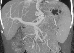 Esophageal and Gastric Varices - CTisus CT Scan