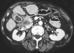 Gallbladder Cancer With Portocaval Nodes - CTisus CT Scan