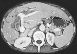 Cholangiocarcinoma - CTisus CT Scan