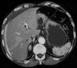 Bleed Around Liver S/P Stent Placement - CTisus CT Scan